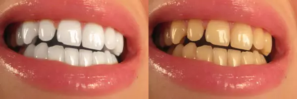 Kuinka valkaista hampaita Photoshopissa