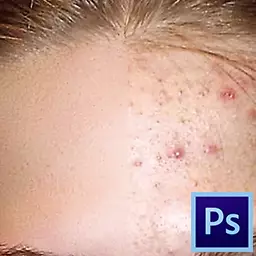 Hoe acne in Photoshop te verwijderen