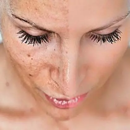 Displays acne online