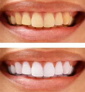 Izrada zuba na bijeloj fotografiji